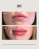 JUVÉDERM® Buy 2, Get 1 FILLER